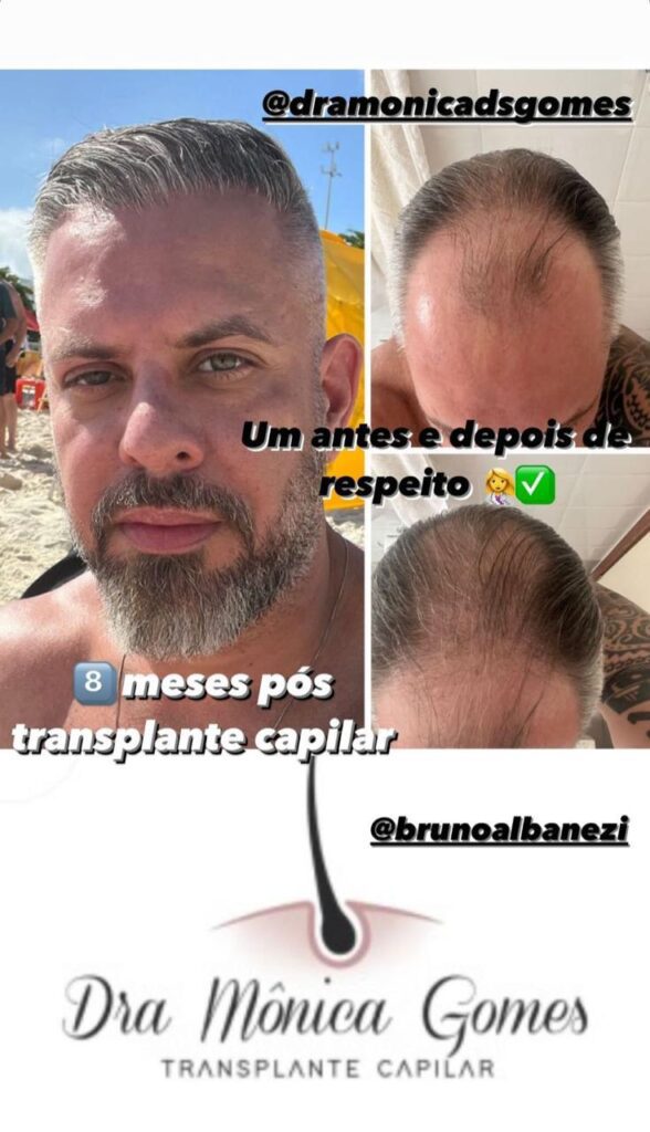 Dra. Mônica Gomes: Referência em Transplante Capilar e Tricologia Médica 2 14efff6e 1abc 4fee 909d 8b19f253de91
