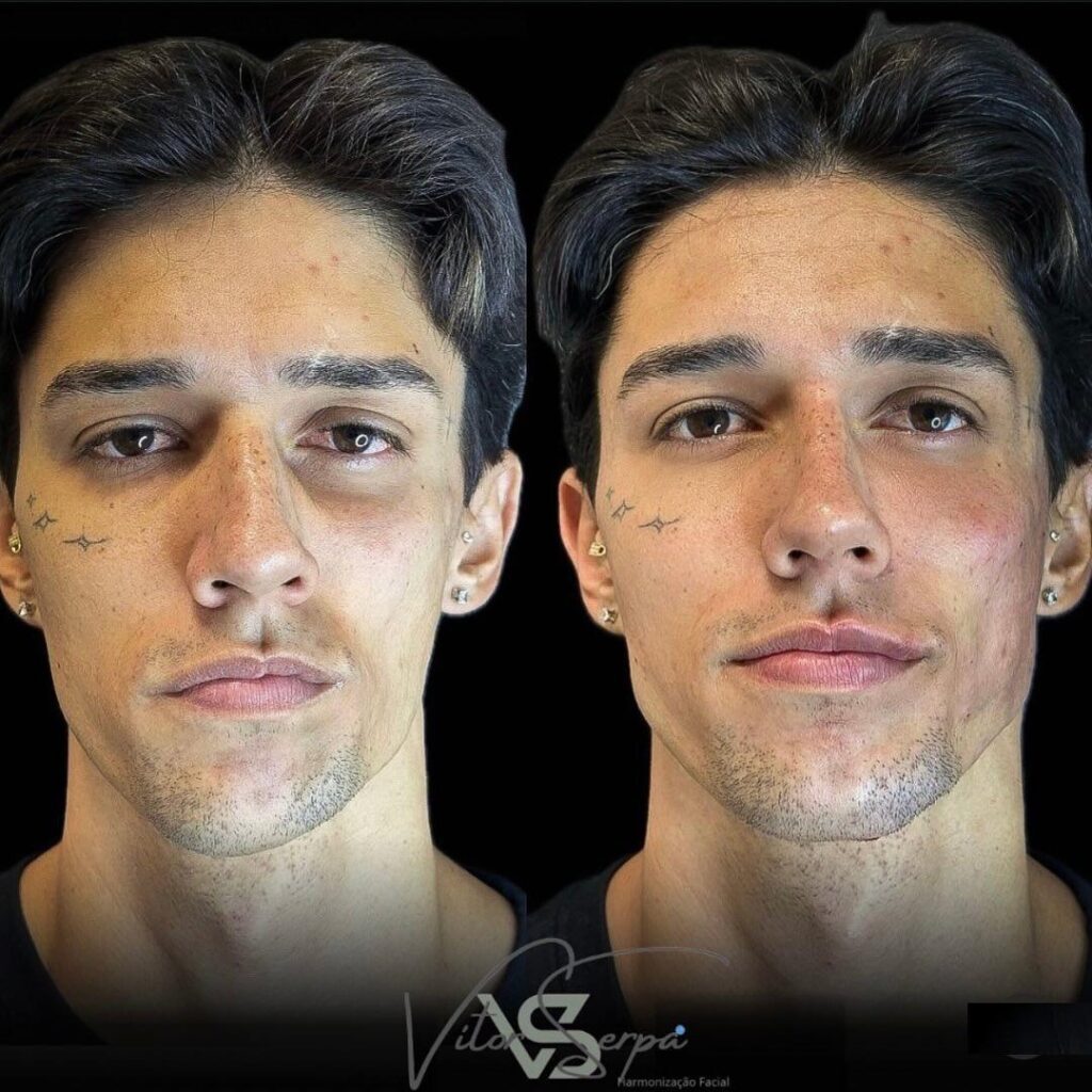 Síndrome de Parry-Romberg: Reabilitação Estética e Funcional com o Dr. Vitor Serpa 1 WhatsApp Image 2024 10 19 at 17.07.39